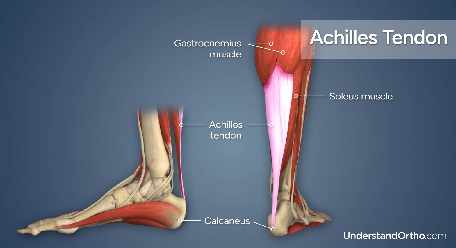 Achilles Tendonitis UnderstandOrtho™