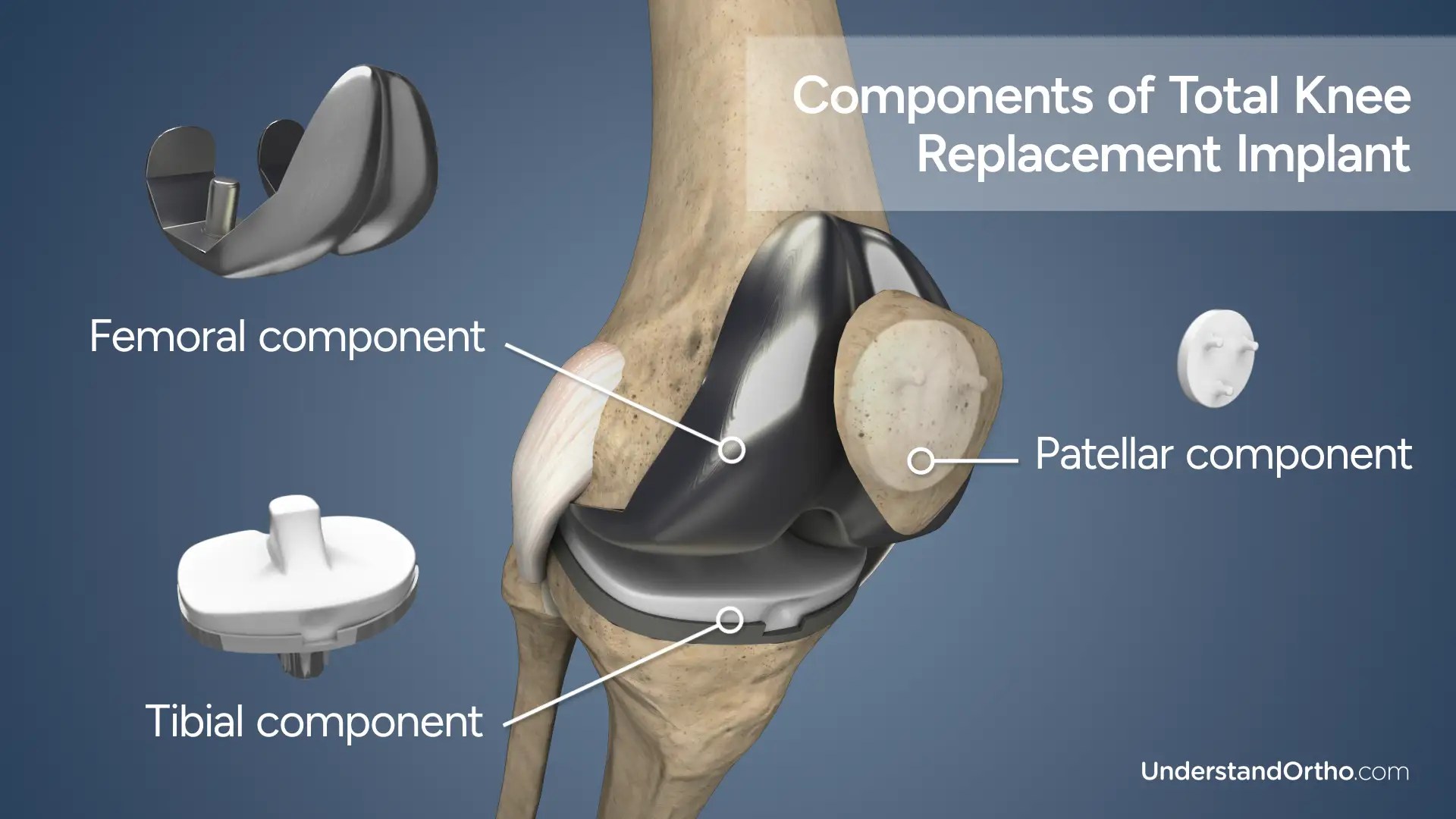 Revision Knee Replacement UnderstandOrtho™