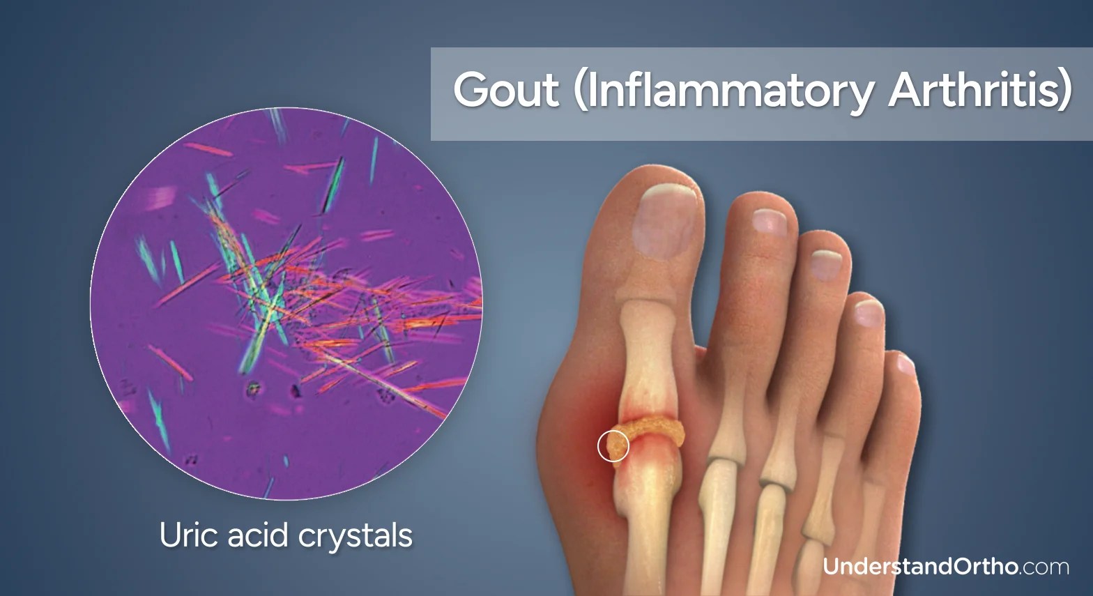 Understanding Gout Causes, Symptoms, and Treatment UnderstandOrtho™