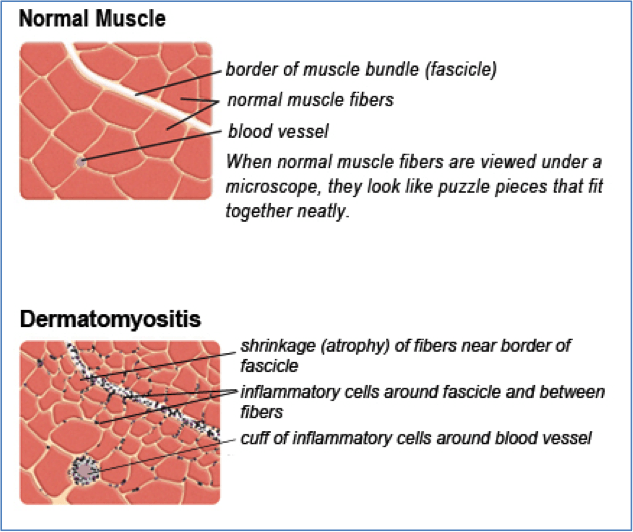 Dermatomyositis Symptoms, Treatments, Cause Myositis Support and
