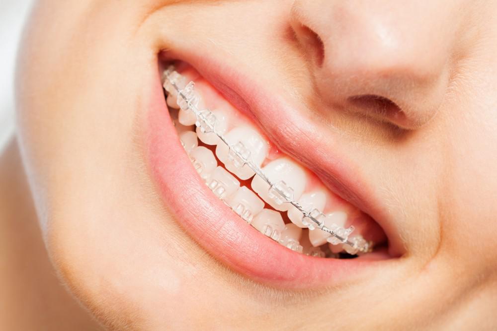 What to Do If Your Braces Break or Get Damaged UNDeFined Sources