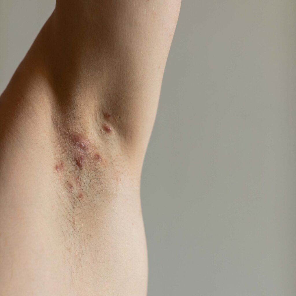 Hidradenitis Suppurativa UNION Therapeutics