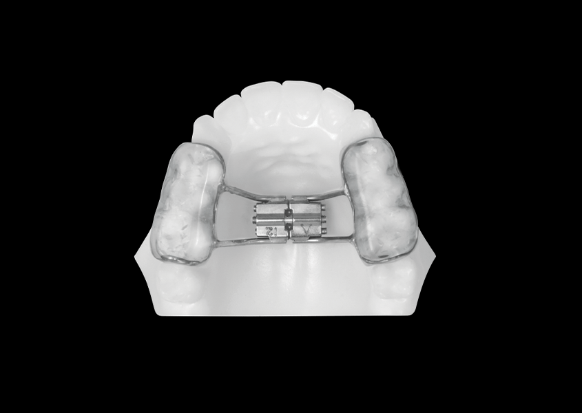 Bonded RPE (Upper Only) Universal Orthodontic Lab