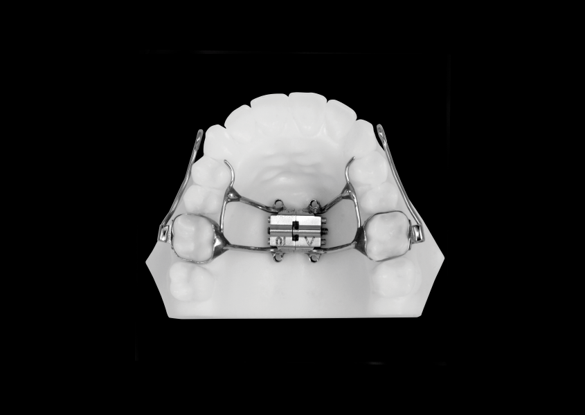 MM.A.R.P.E.® (MicroImplant Assisted Rapid Palatal Expander
