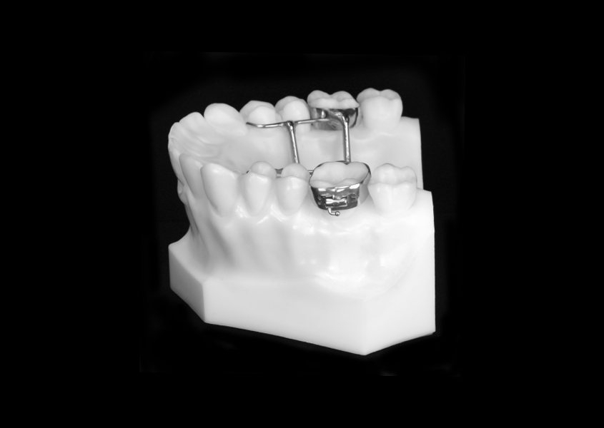 MM.A.R.P.E.® (MicroImplant Assisted Rapid Palatal Expander