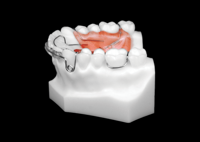 Open Spring Retainer (Upper) Universal Orthodontic Lab