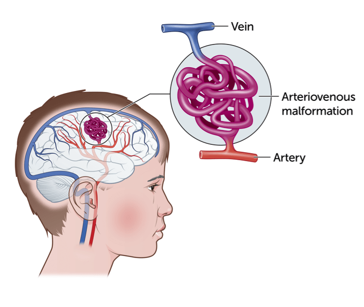 ARTERIOVENOSUS MALFORMATION Unitamed