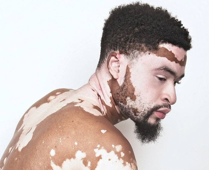10 Most Attractive Vitiligans (2018) Men Unite For Vitiligo