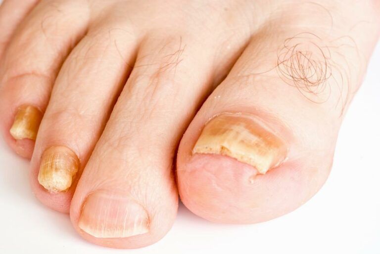 The Toenail Fungus Universal Health Products