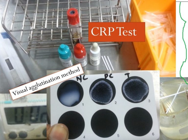 CRP test Introduction, testing procedure, normal range and clinical
