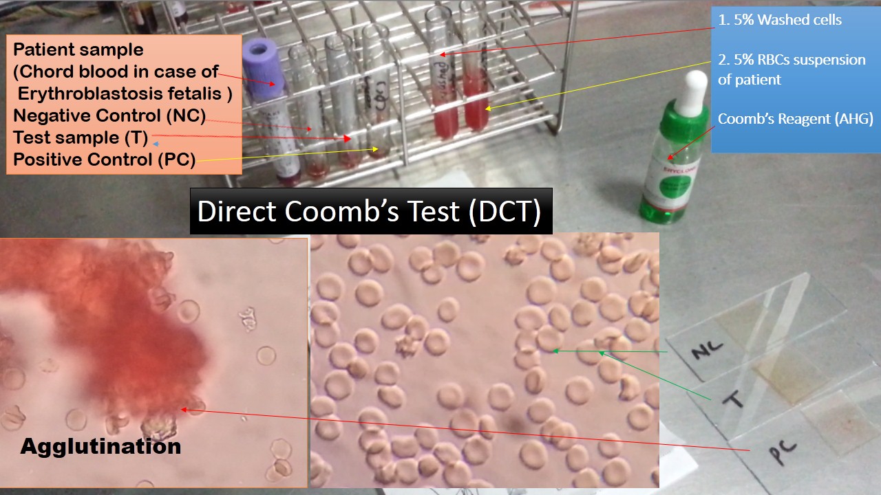 Direct Coomb Test (DCT) Introduction, Principle, Procedure, Result Interp