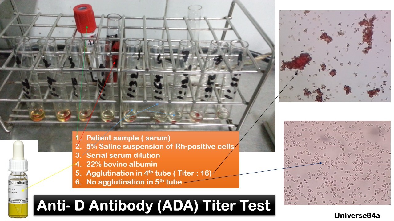 ADA Titer Introduction, Principle, Procedure, Result Interpretation and