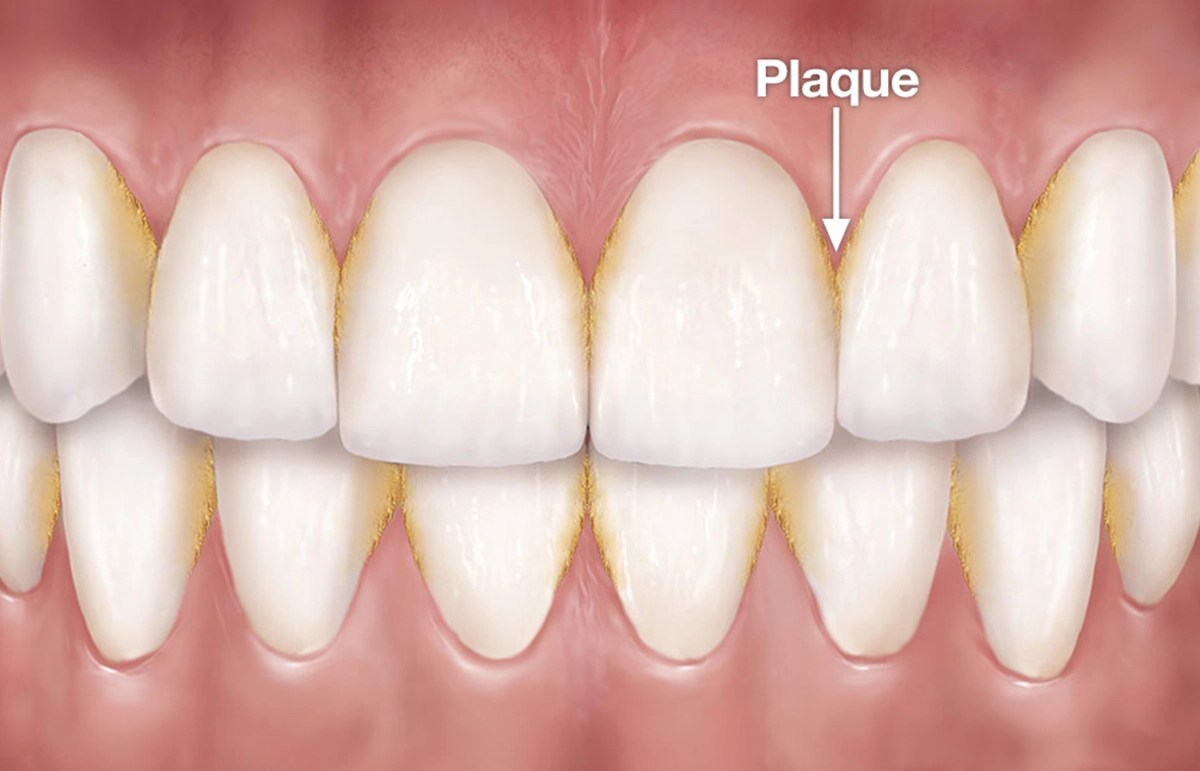 How to Remove Plaque from Teeth? University Ave Dental