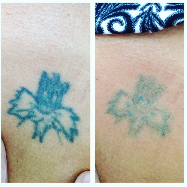 Laser Tattoo Removal Before & After Photos Birmingham