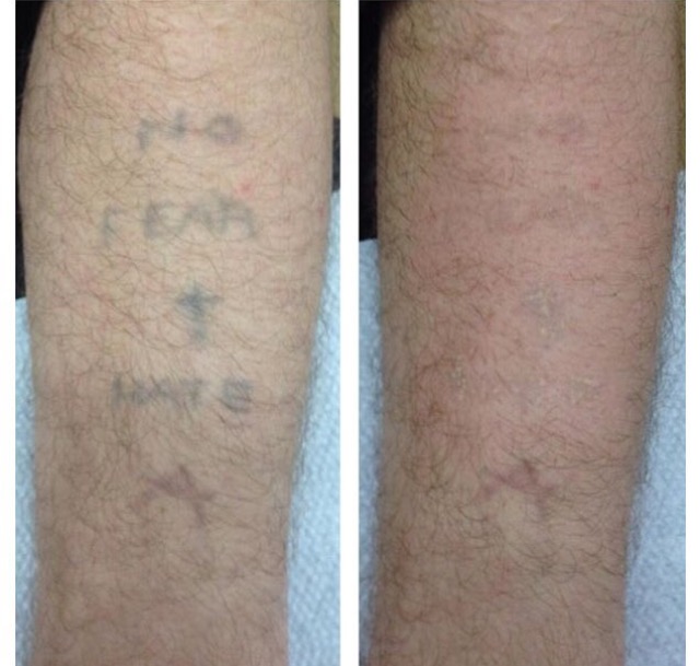 Laser Tattoo Removal Before & After Photos Birmingham