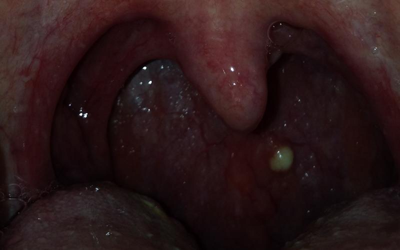 Pickelartiges etwas im Rachen, Halsschmerzen bzw. Kratzen, Was könnte das sein? (Entzündung