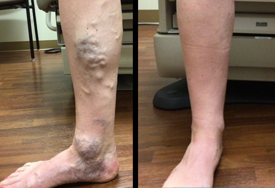Immediate, NonSurgical Relief Available for Varicose Veins