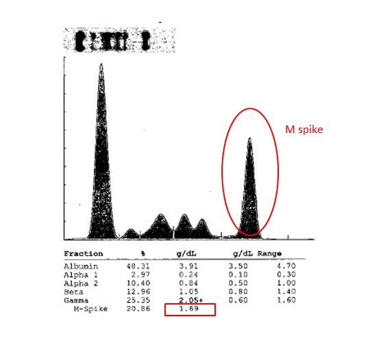 Multiple Myeloma Oncology Medbullets Step 2/3