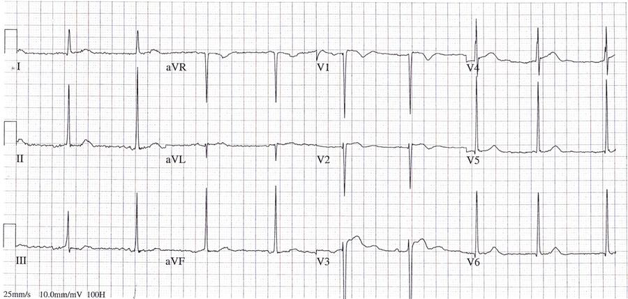 Aortic Dissection Cardiovascular Medbullets Step 2/3