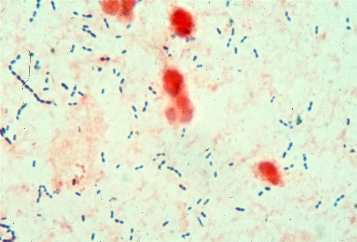 Streptococcus pneumoniae Microbiology Medbullets Step 1