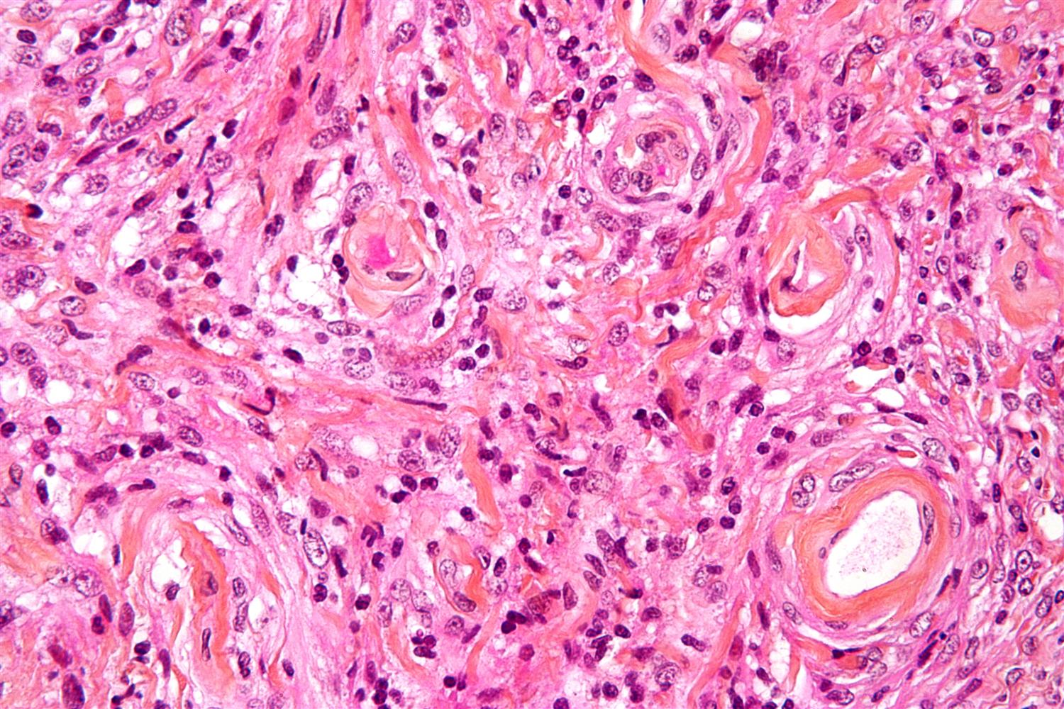 Spongiform Encephalopathy / CreutzfeldtJakob Disease Neurology