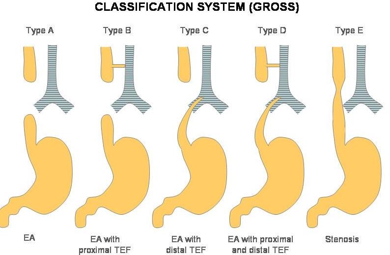 Tracheoesophageal Fistula 100 Best Explanation