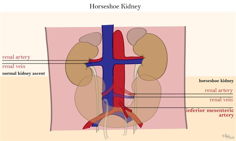 Kidney Embryology Embryology Medbullets Step 1