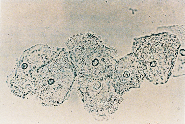 Gardnerella vaginalis Microbiology Medbullets Step 1