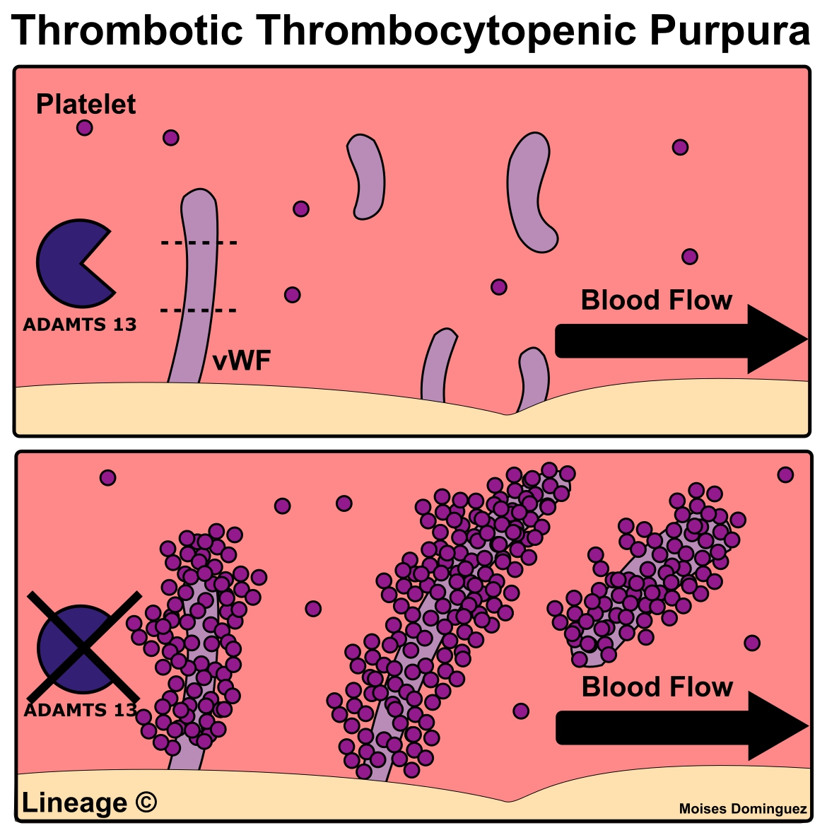 Thrombotic Thrombocytopenic Purpura (TTP) Hematology Medbullets Step 1