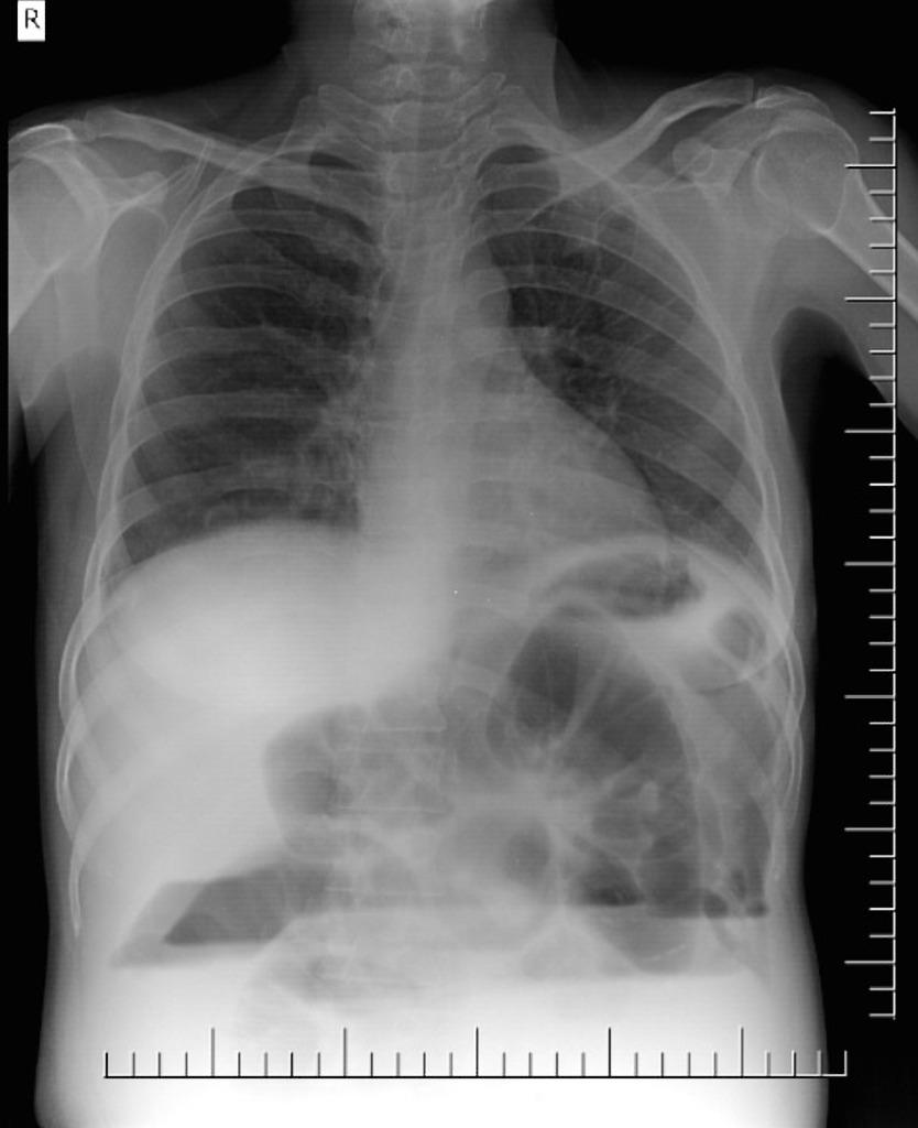 Small Bowel Obstruction Gastrointestinal Medbullets Step 2/3