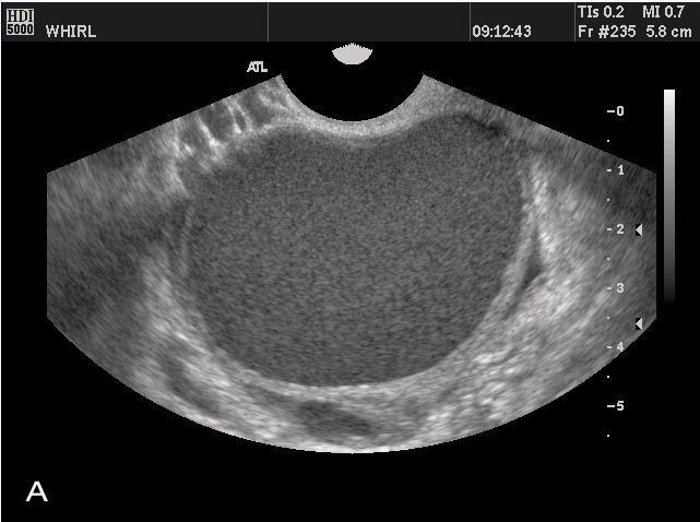 Endometriosis - Gynecology - Medbullets Step 2/3