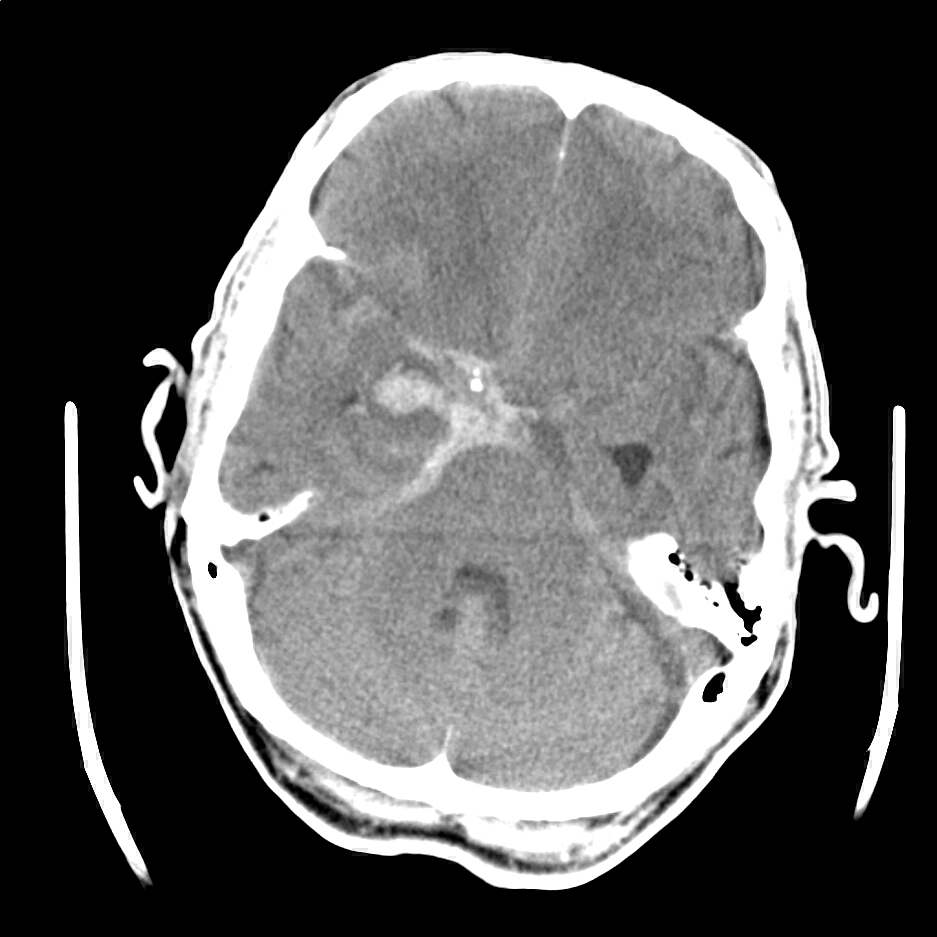 Subarachnoid Hemorrhage Neurology Medbullets Step 2/3