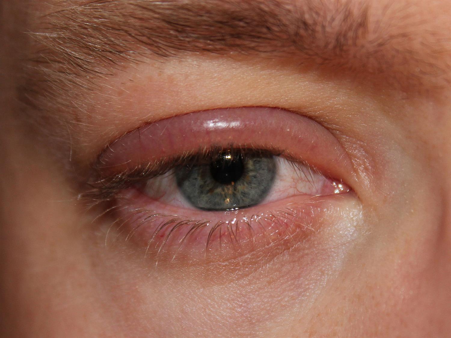 Blepharitis Ophthalmology Medbullets Step 2/3