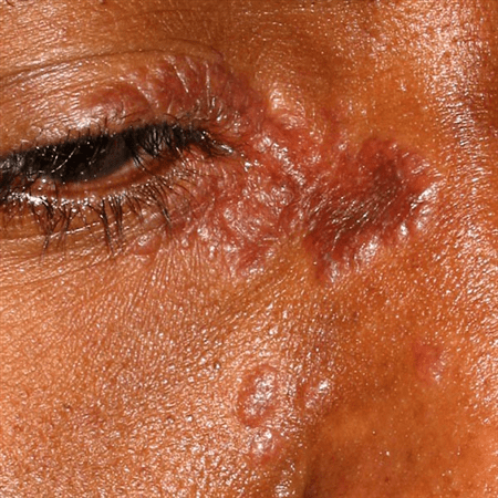 SARCOIDOSIS Causes , Treatments , Symptoms , Stages