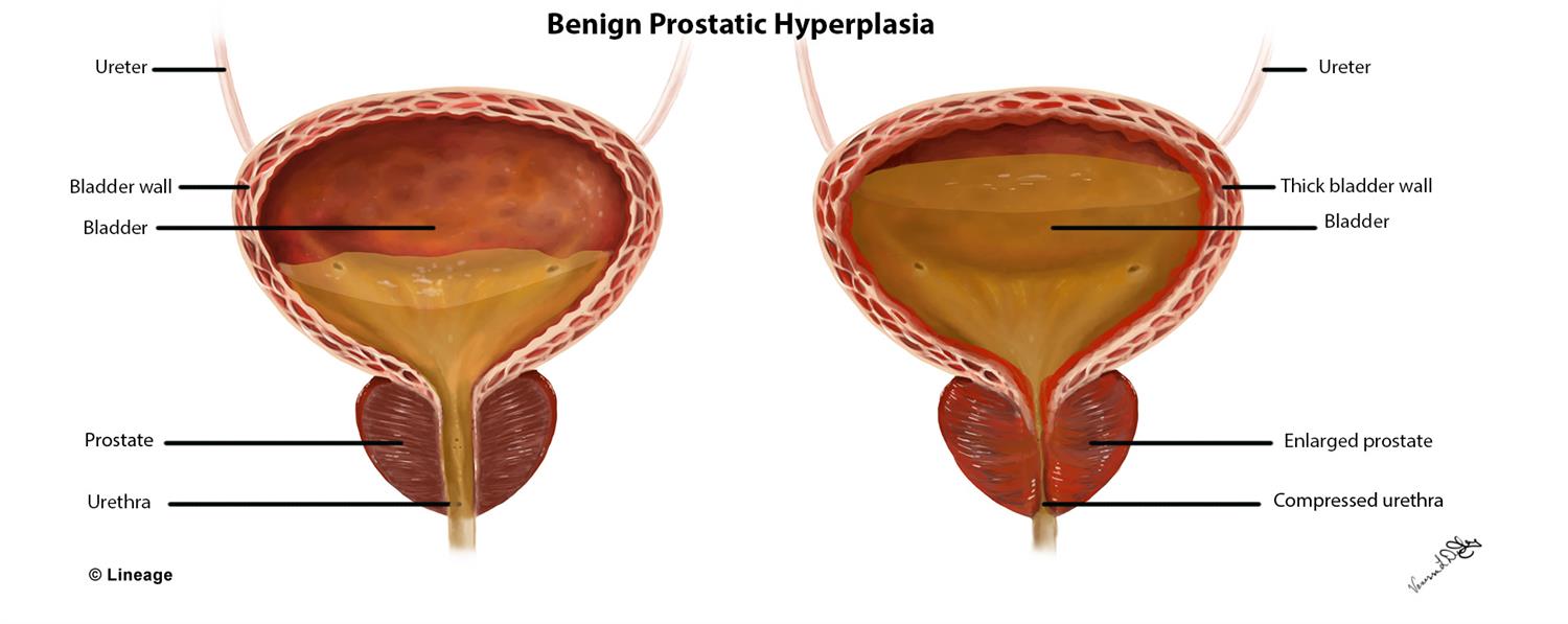 Benign Prostatic Hyperplasia (BPH) Renal Medbullets Step 2/3