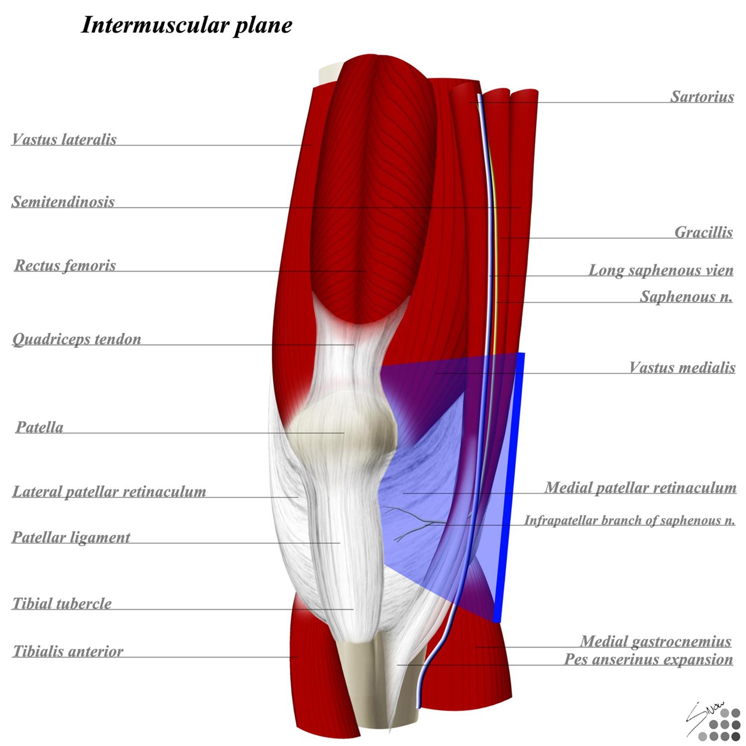Knee Parapatellar Approach Anatomy Medbullets Step 2/3