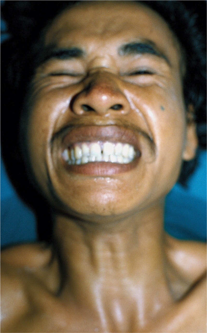 Tetanus Infectious Dis. Medbullets Step 2/3