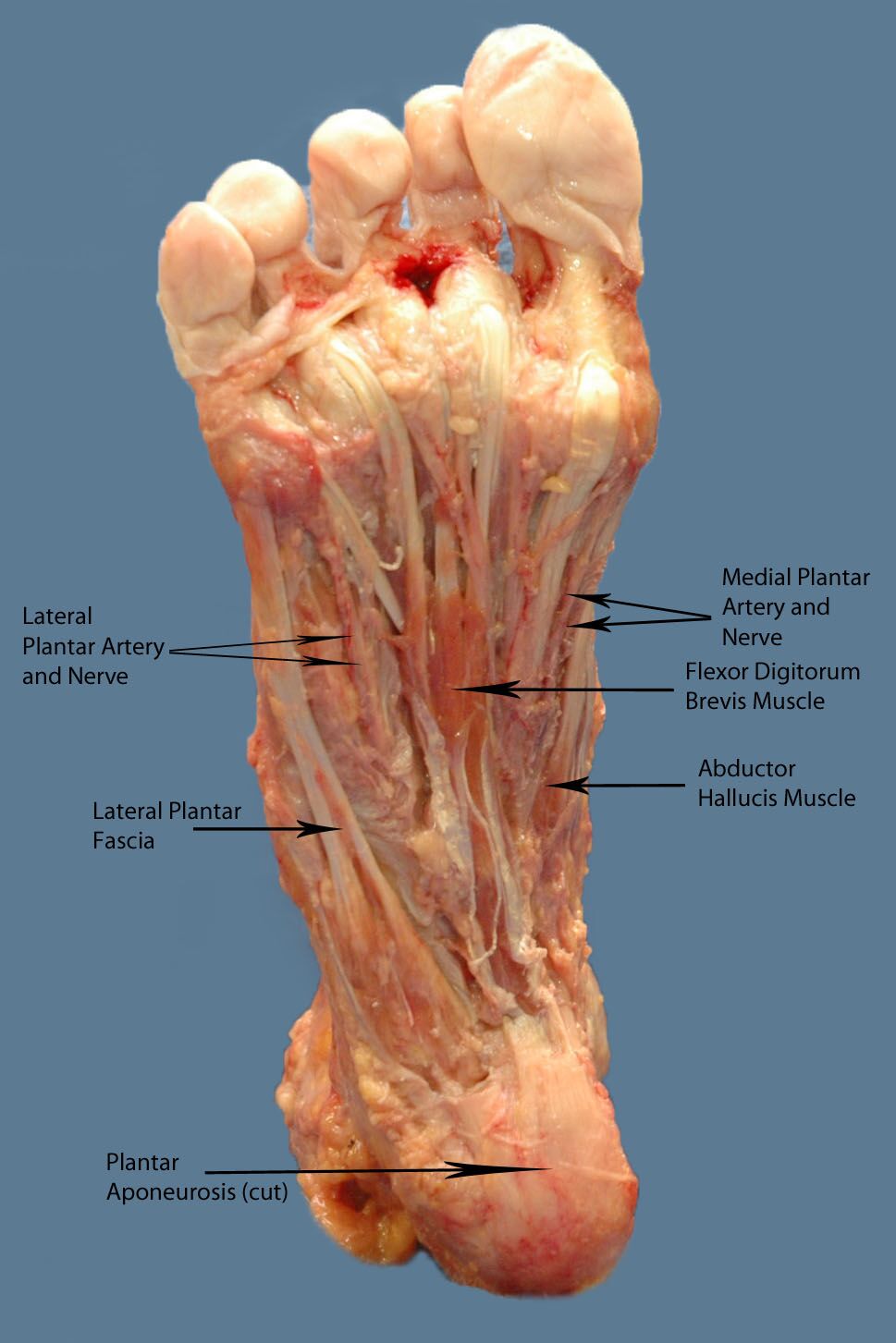 Abductor Hallucis Anatomy Medbullets Step 1