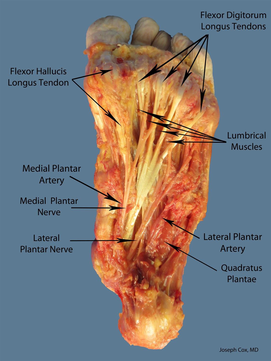 Lumbrical (1 MPN, 14 LPN) Anatomy Medbullets Step 1
