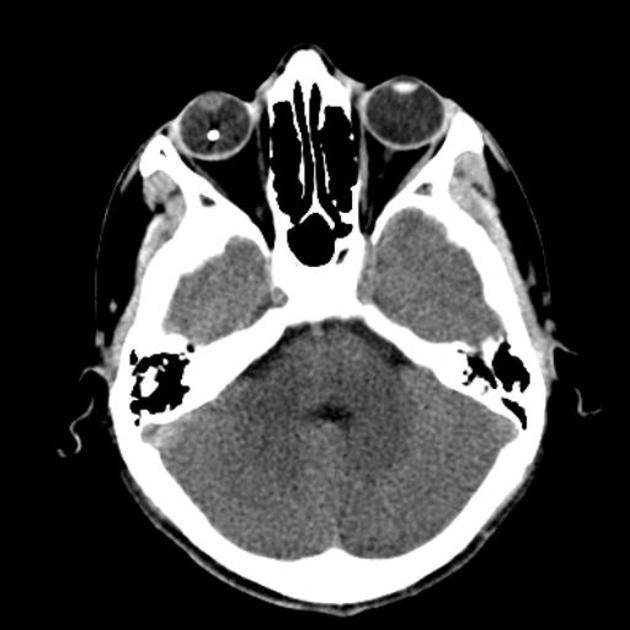 Common Eye Injuries Ophthalmology Medbullets Step 2/3