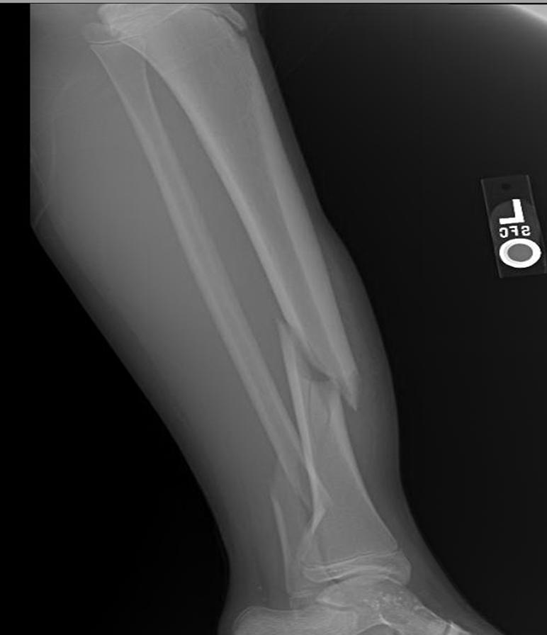 Tibial Shaft Fracture Pediatric Pediatrics Orthobullets