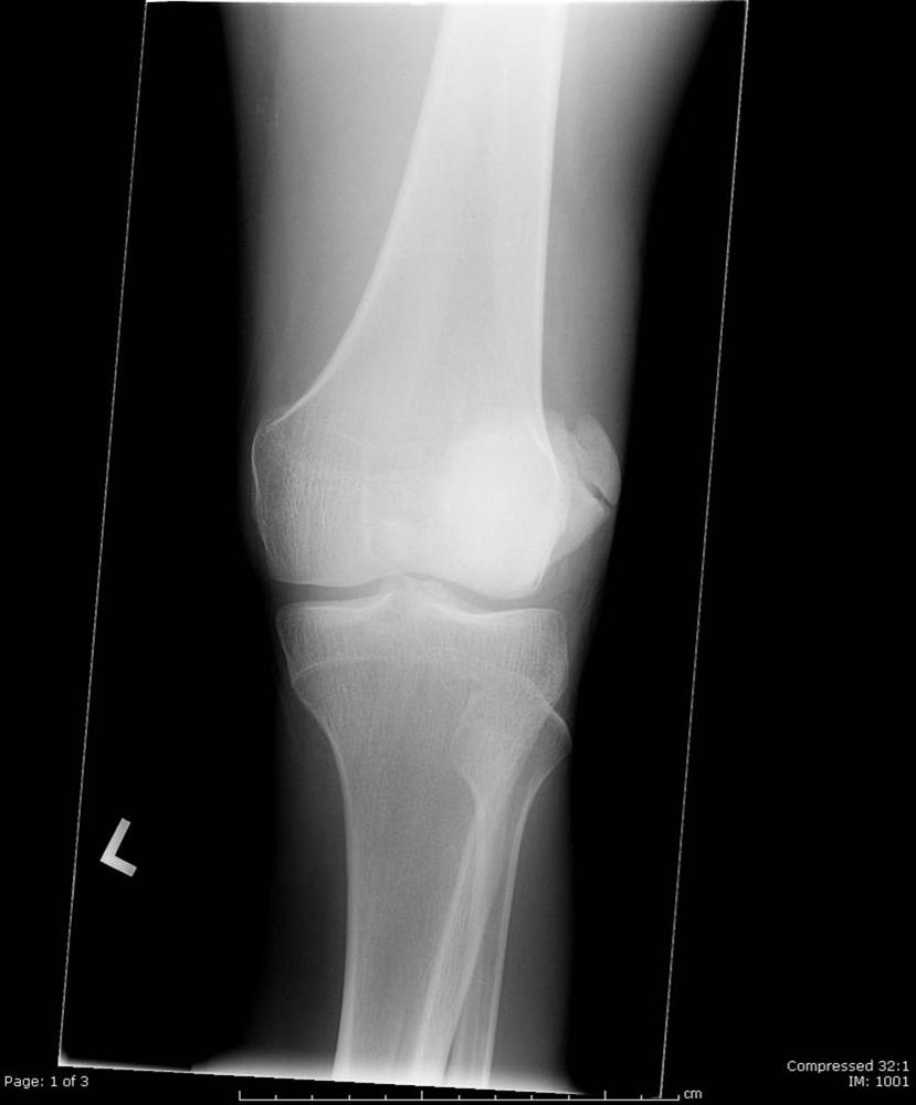 Patellar Instability Knee & Sports Orthobullets