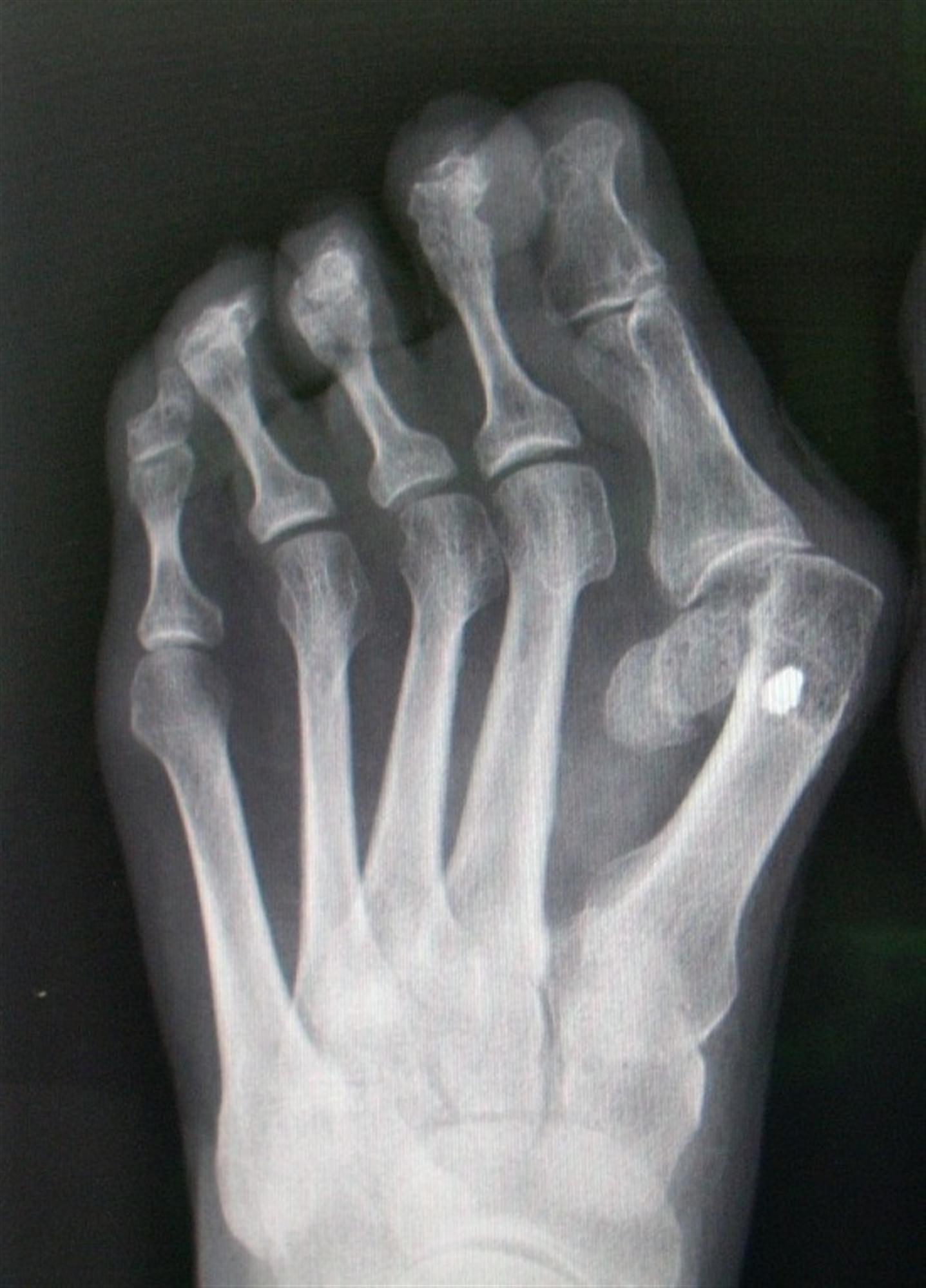 Hallux Valgus Foot & Ankle Orthobullets