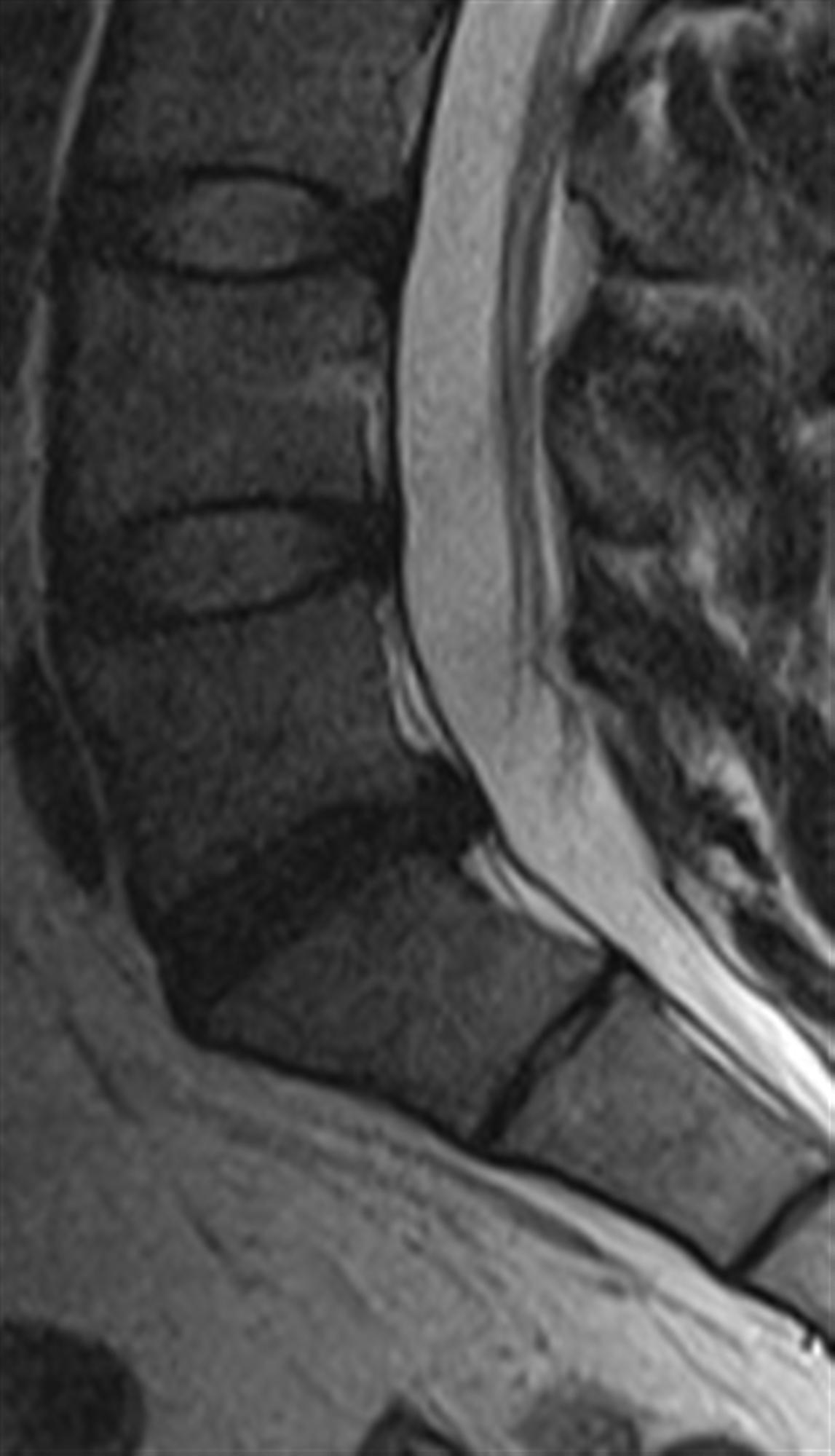 Lumbar Disc Herniation Spine Orthobullets