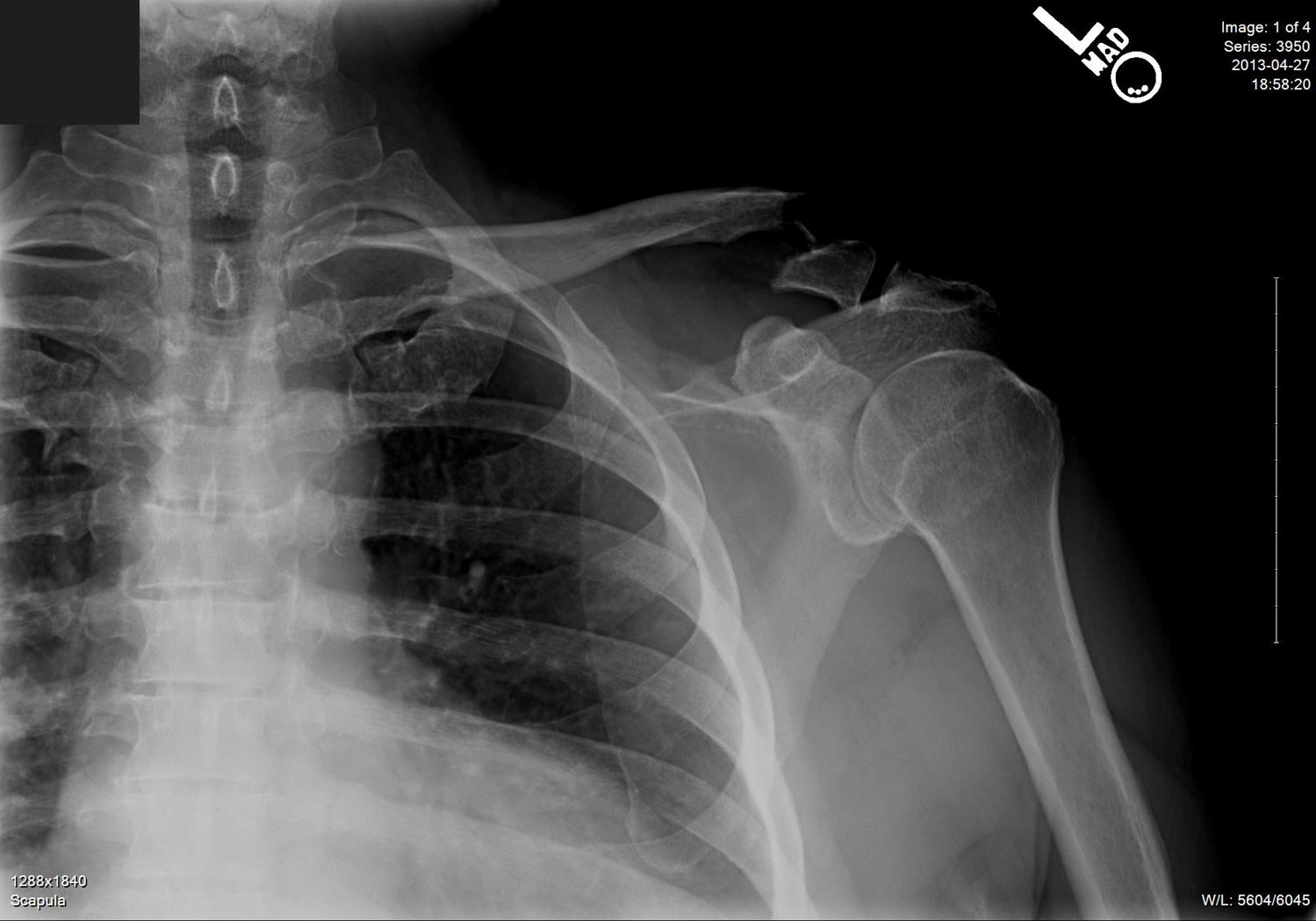 Clavicle Shaft Fractures Trauma Orthobullets