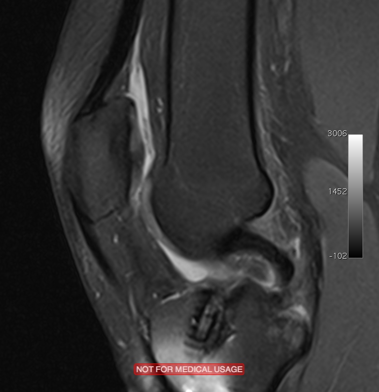 Articular Cartilage Defects of Knee Knee & Sports Orthobullets