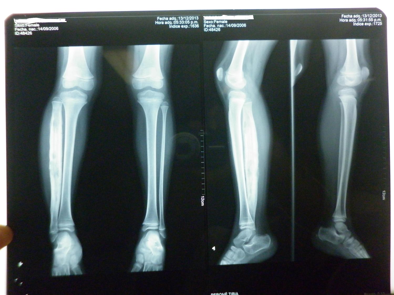 Osteomyelitis Pediatric Pediatrics Orthobullets