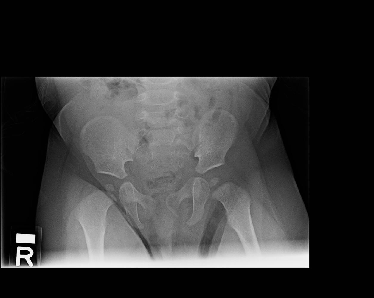 Hip Septic Arthritis Pediatric Pediatrics