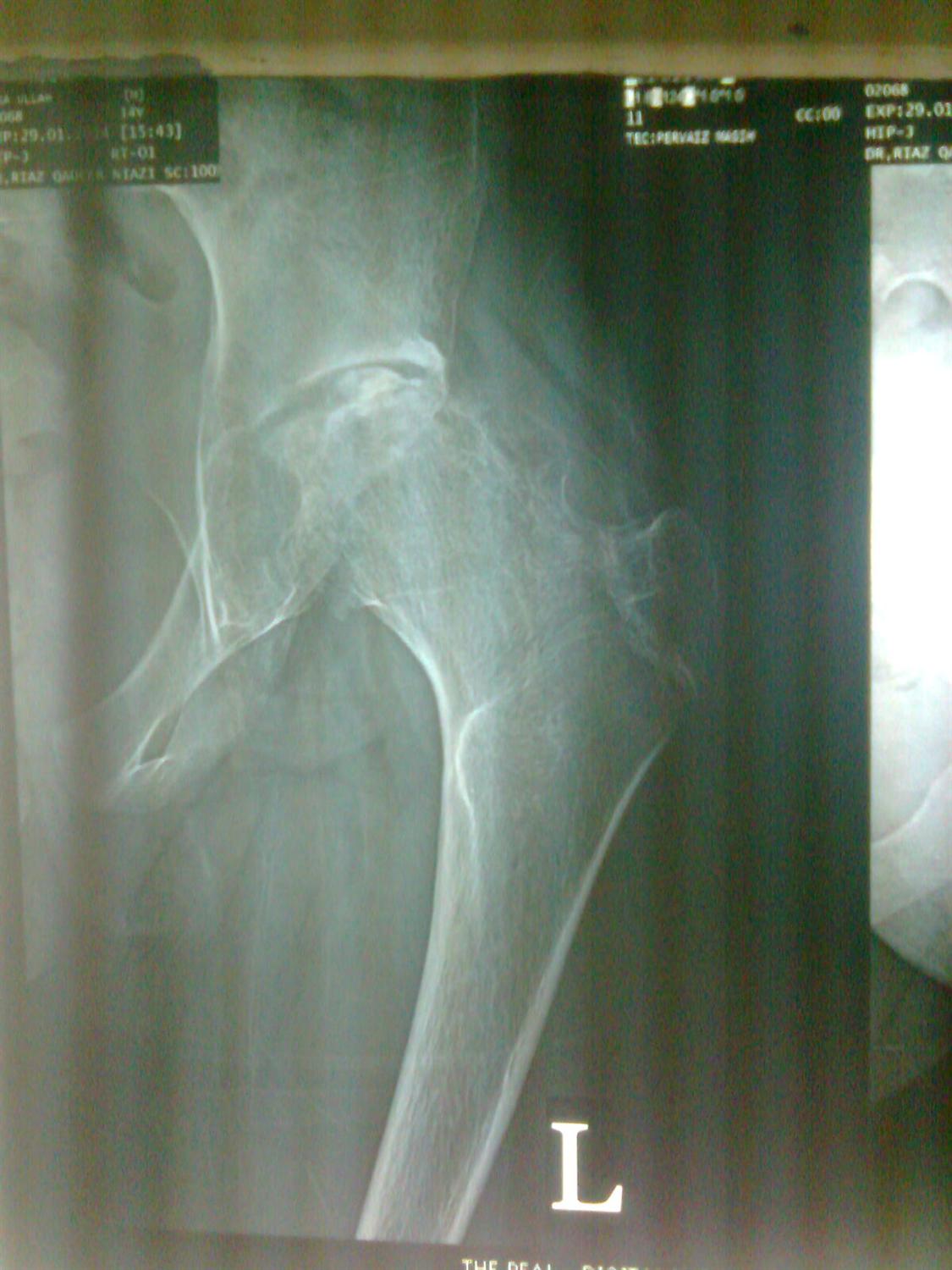 Hip Septic Arthritis Pediatric Pediatrics Orthobullets