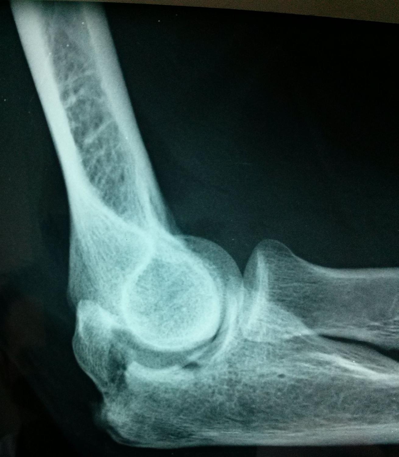 Olecranon Fractures Trauma Orthobullets